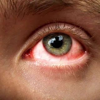 Nahaufnahme gerötetes Auge