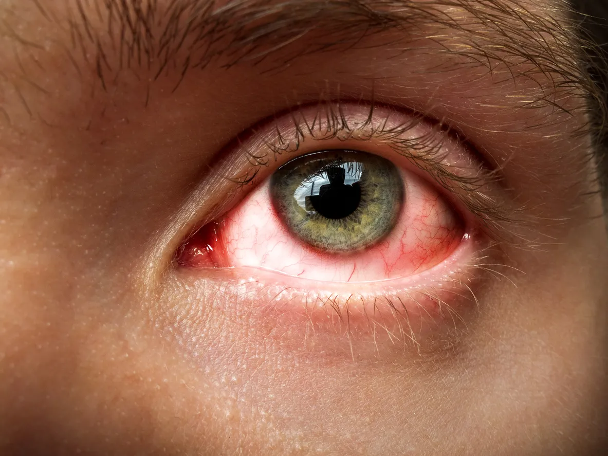 Nahaufnahme gerötetes Auge